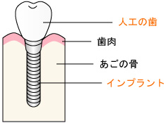 インプラントとは？